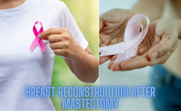 BREAST RECONSTRUCTION AFTER MASTECTOMY