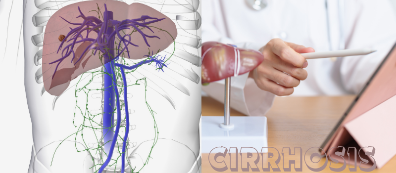 CIRRHOSIS