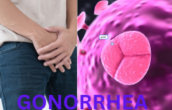 Understanding Gonorrhea: Symptoms, Treatments, and Prevention