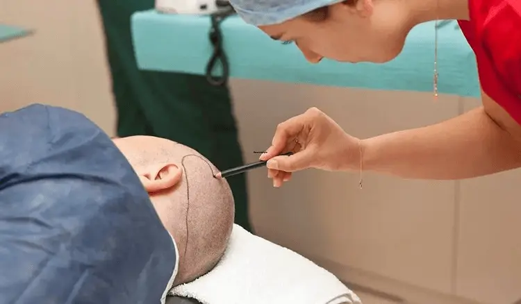 Hair Transplant: Is it Safe for individuals with diabetes