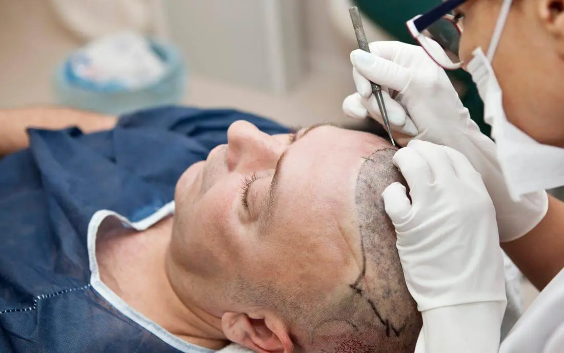 Hair Transplant: Is it Safe for Sugar Patients?