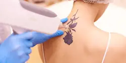 Tattoo Removal