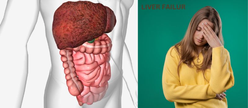 Understanding Liver Failure