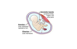  Understanding Amniotic Band Syndrome: A Complex Web of Challenges