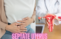   Understanding Septate Uterus: Causes, Symptoms, and Treatment Options