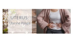  Understanding Uterine Polyps: Causes, Symptoms, and Treatment