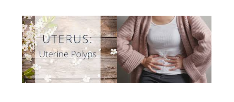 Understanding Uterine Polyps: Causes, Symptoms, and Treatment