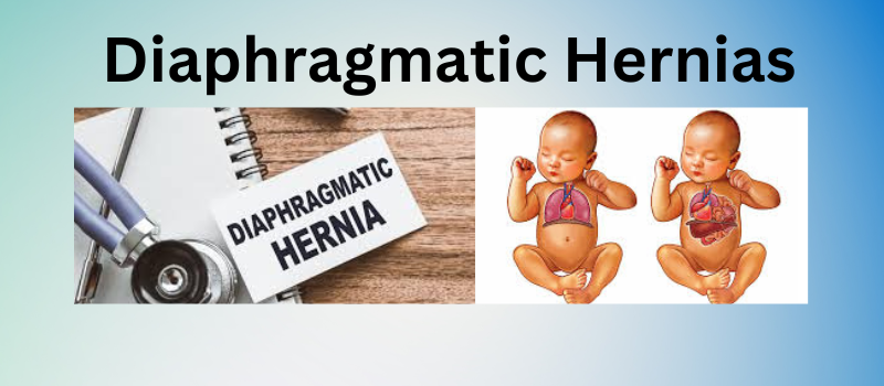 Understanding Diaphragmatic Hernias: Symptoms, Causes, and Treatment