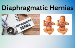 Understanding Diaphragmatic Hernias: Symptoms, Causes, and Treatment