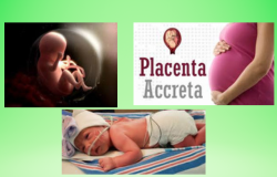 Understanding Placenta Accreta: A Complex Pregnancy Condition