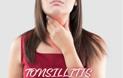 Understanding Tonsillitis: Causes, Symptoms, and Treatment