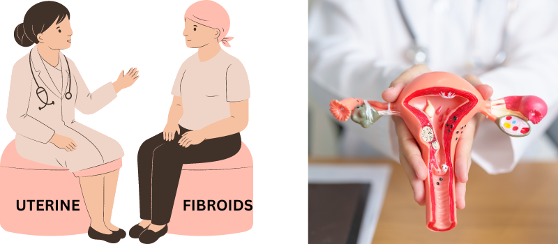 Understanding Uterine Fibroids: Causes, Symptoms, and Treatment Options