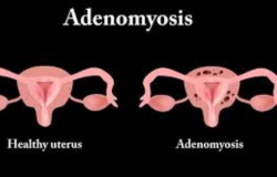 Unraveling the Enigma: Understanding Adenomyosis