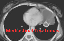 Unveiling the Intriguing World of Mediastinal Teratomas: A Fascinating Journey into Medical Marvels