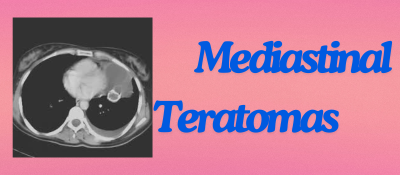 Unveiling the Intriguing World of Mediastinal Teratomas: A Fascinating Journey into Medical Marvels