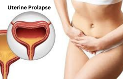 Understanding Uterine Prolapse: Causes, Symptoms, and Treatment Options