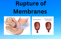 Understanding the Rupture of Membranes: What You Need to Know