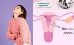 Unraveling the Enigma of Intrauterine Adhesions: A Deep Dive into Asherman