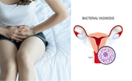 Unveiling the Veil of Bacterial Vaginosis: Understanding, Treatment, and Prevention